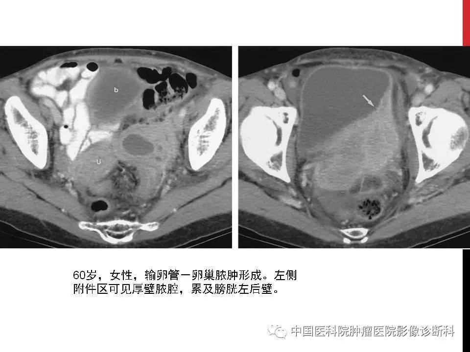 简便,快捷(异位妊娠破裂出血,卵巢黄体囊肿破裂出血,观察盆腔积液情况