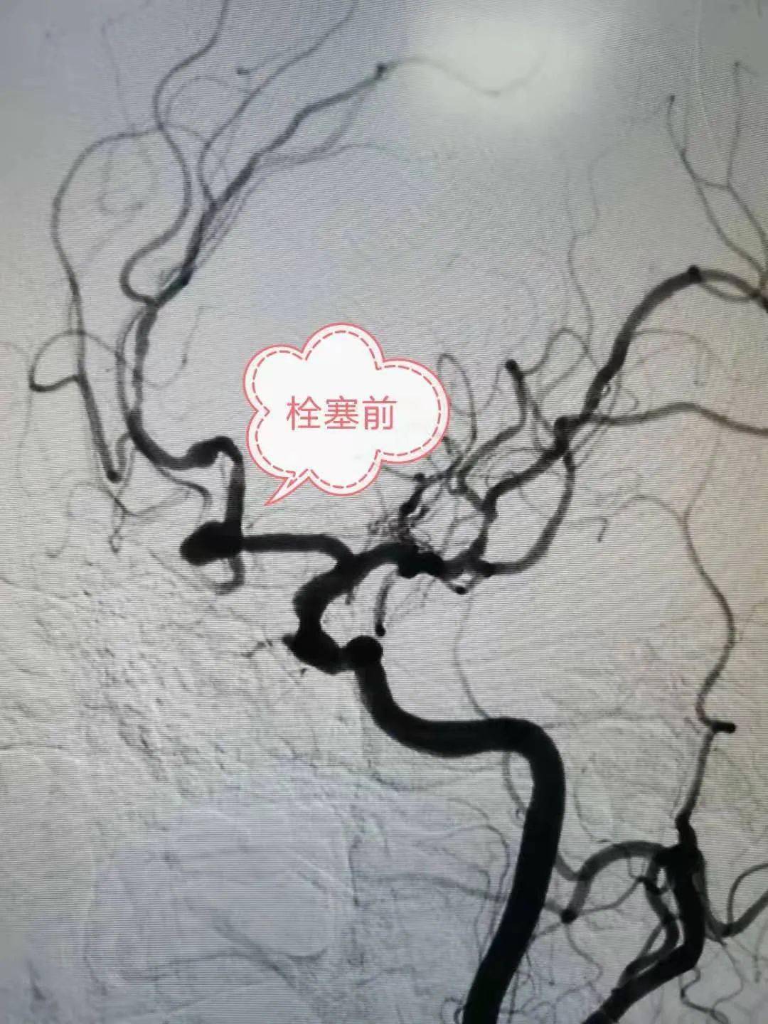 技术良医良技在身边我院外二科成功完成破裂颅内动脉瘤栓塞术