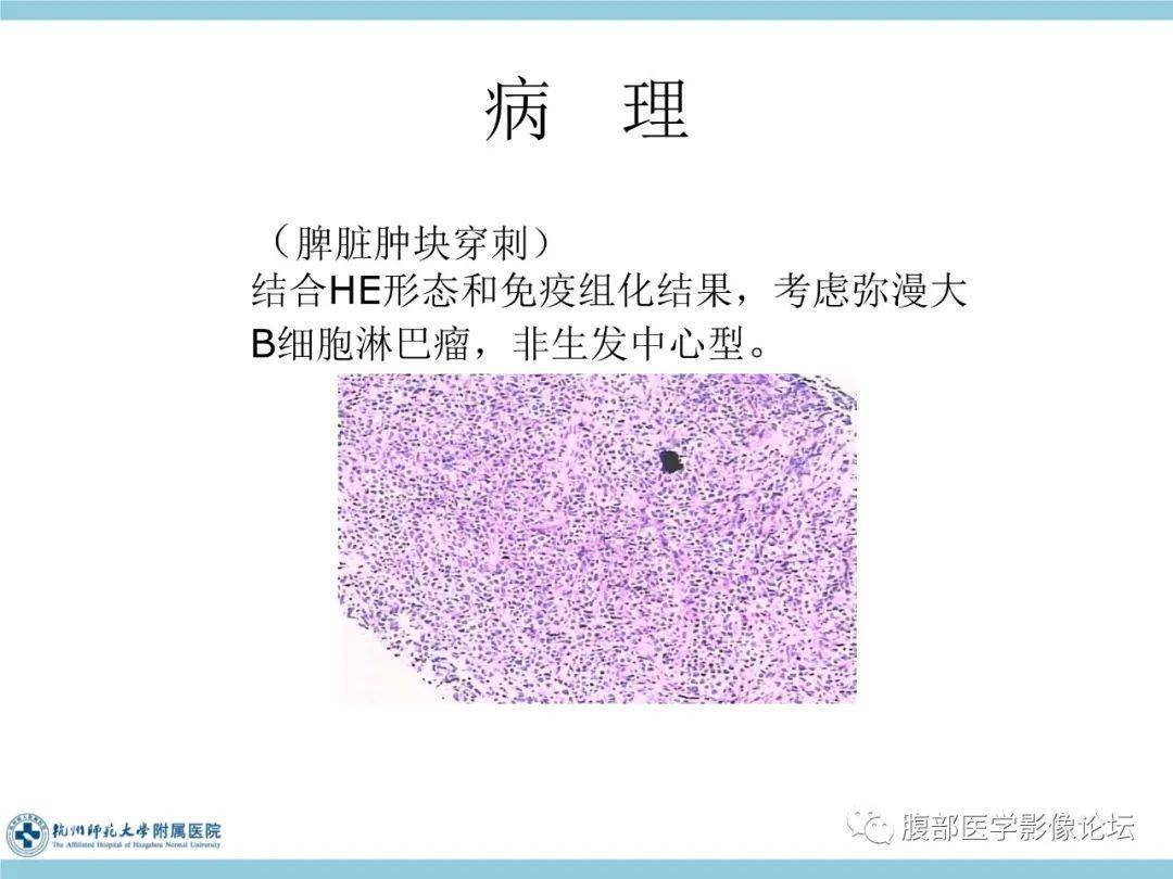 脾脏丨弥漫大b细胞淋巴瘤