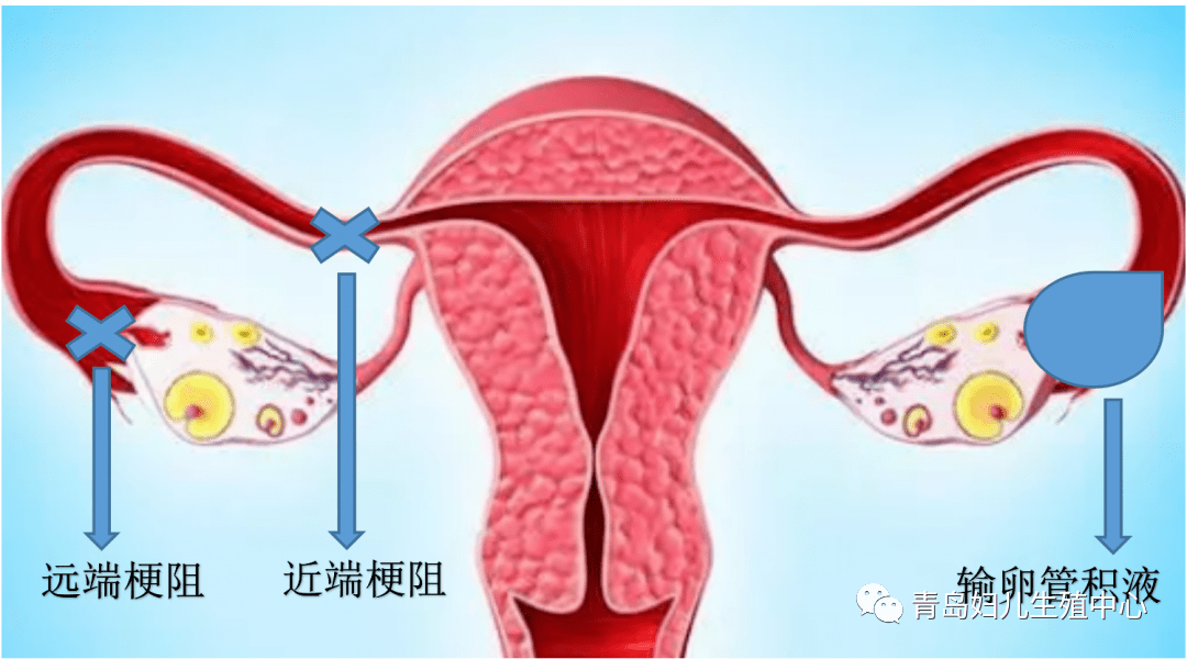 可以检查输卵管近端和远端的阻塞,显示峡部的结节性输卵管炎,了解