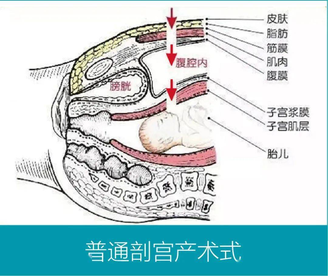 angel手术室同样是剖宫产这位妈妈的新腹膜外剖宫产有啥不一样