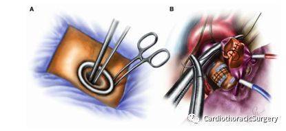 单孔胸腔镜:双袖切的技术要点(diego gonzalez-rivas)