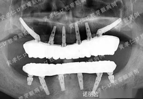 双侧穿颧骨全口种植