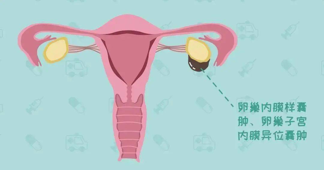 卵巢子宫内膜异位囊肿的手术治疗和手术方式有哪些