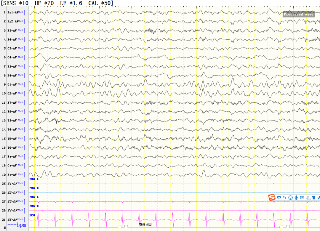 清醒期脑电图(治疗后)