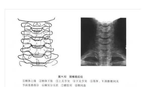 棘突是否居中,排列有无侧弯及其他异常;第7颈椎双侧横突是否