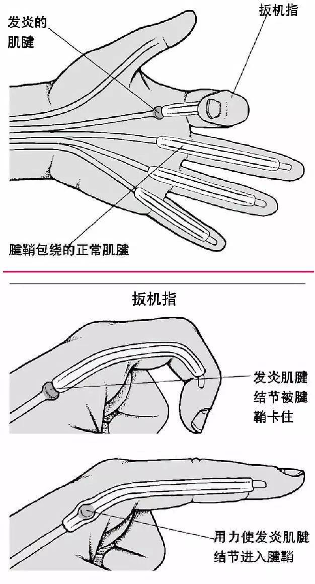 以拇指,食指,中指多见.