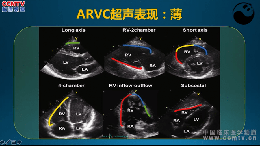 5步法读懂超声心动图,90%的医生都不知道!