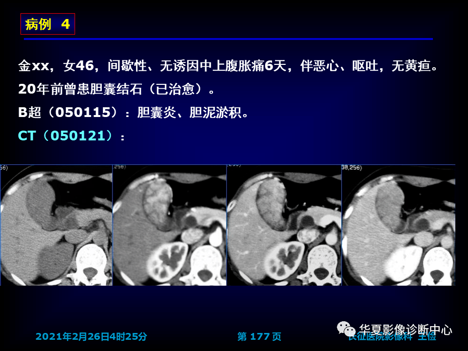 胆囊炎影像诊断