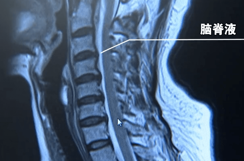 9岁小学生颈椎变成一条直线,家长发现时已晚了!快看看