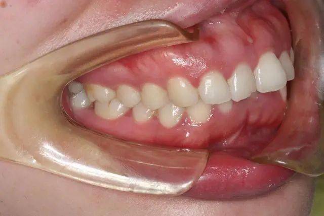 龅牙是深覆颌还是深覆盖怎样区分