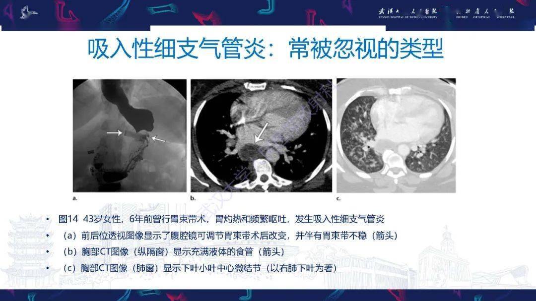 细支气管炎影像诊断