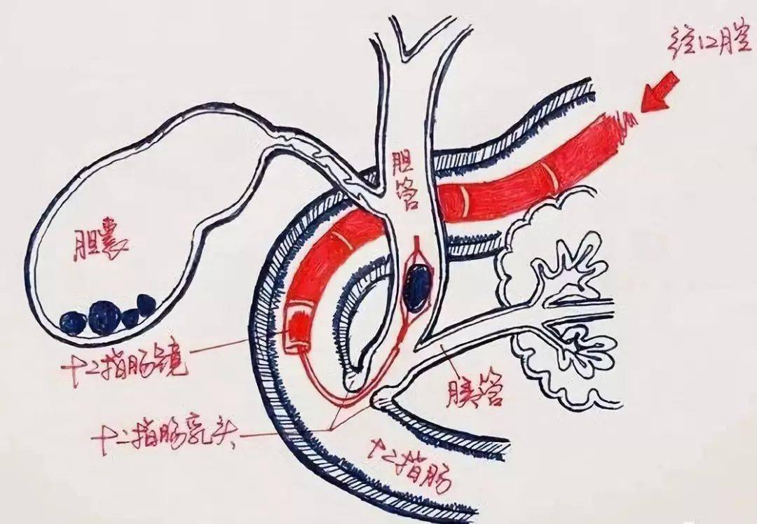 切还是不切?_胆囊