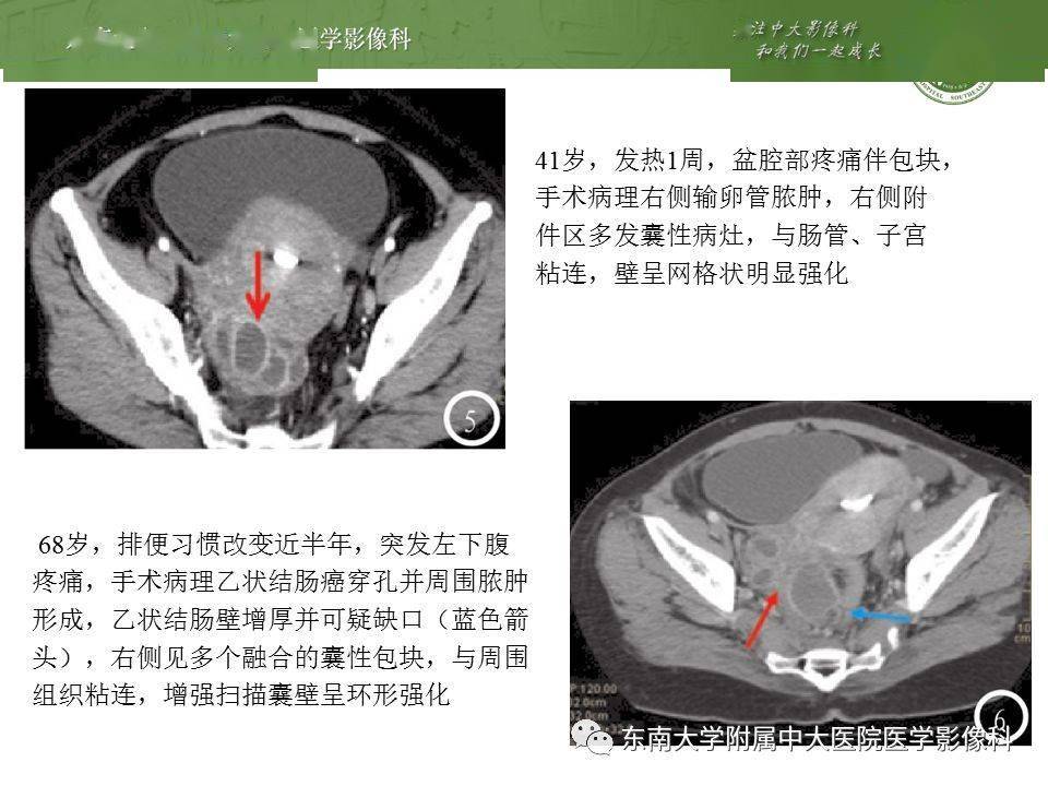 卵巢囊肿蒂扭转影像表现