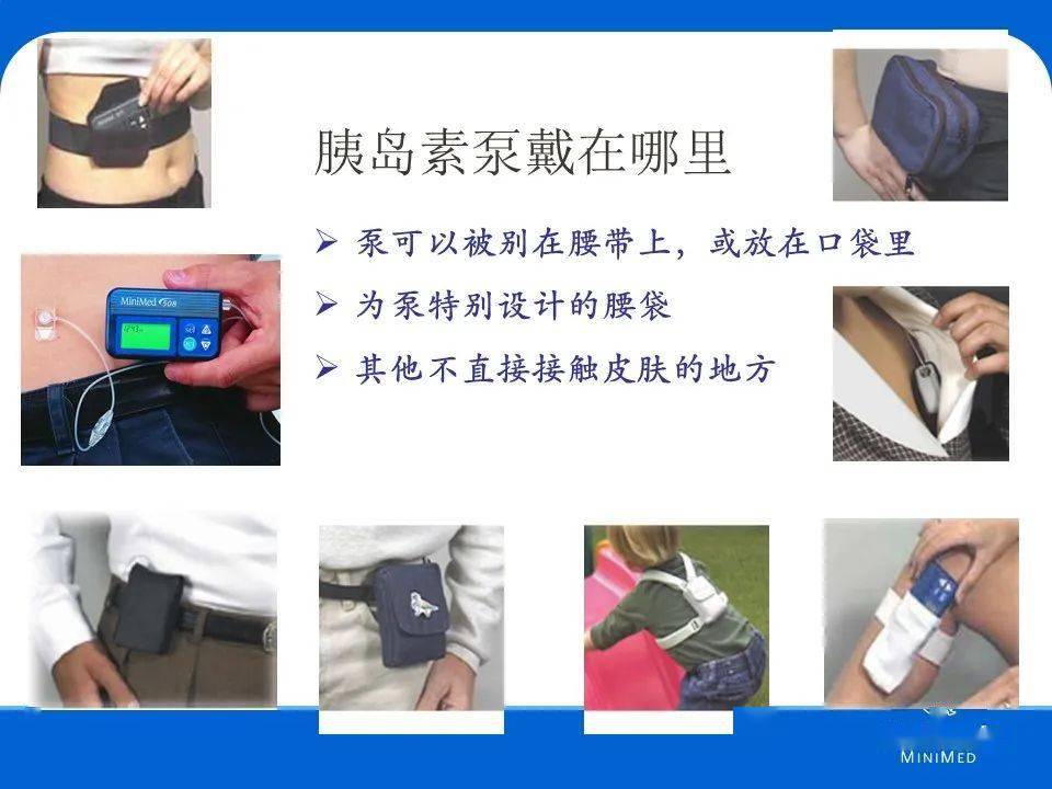 【ppt】胰岛素泵的使用(下)