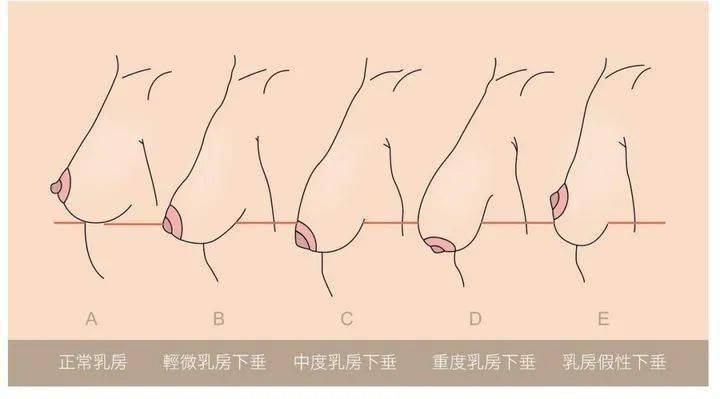 女生胸部最标准的4个形状(男生禁入)