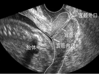 孕期宫颈怎样