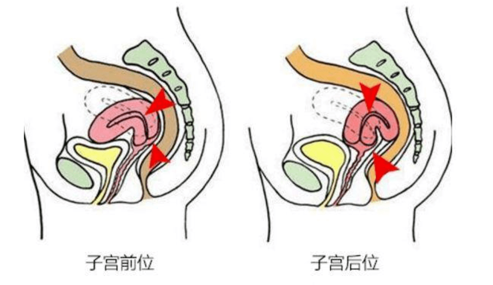 子宫后位会不会影响怀孕?