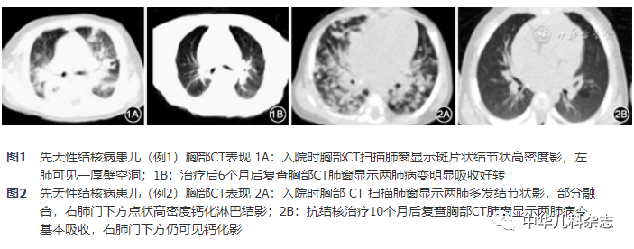 【病例报告】先天性结核病三例