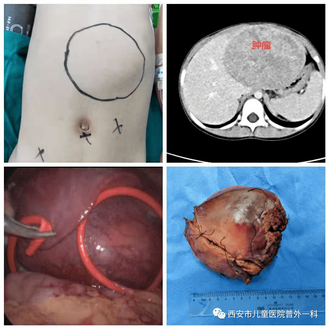 最大9岁,最小半岁,肝母细胞瘤,肝癌是咋找上小朋友的?