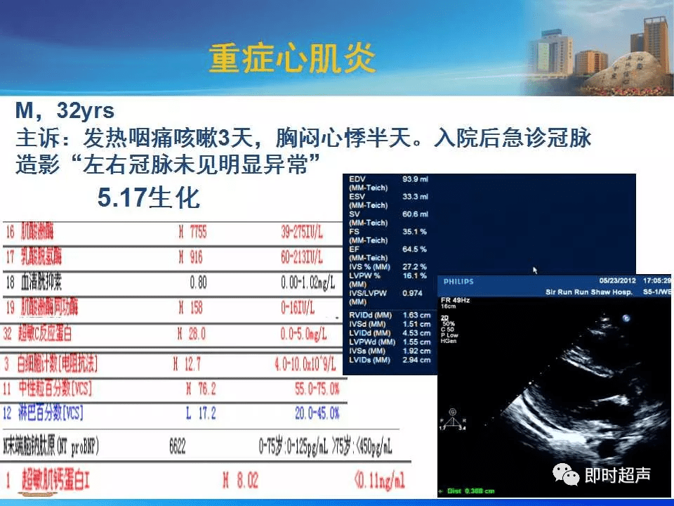 左室肥厚的超声心动图诊断思路