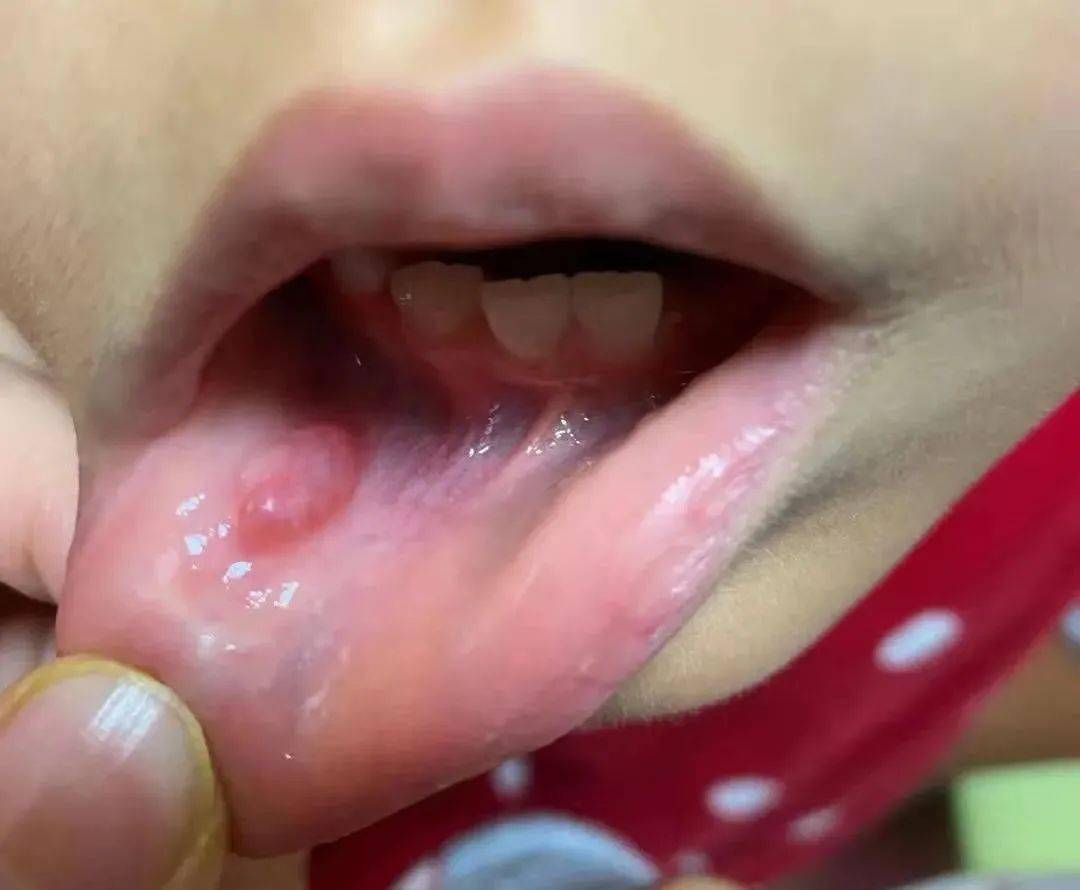 的嘴唇,可以摸到很多疙瘩球状的组织,这是口腔黏膜里丰富的黏液腺体
