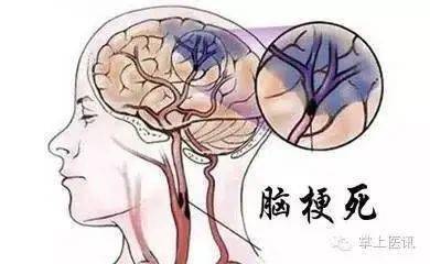 脑梗死,脑血栓及脑出血的区别