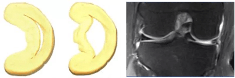 膝关节半月板病变的 mri 诊断与鉴别