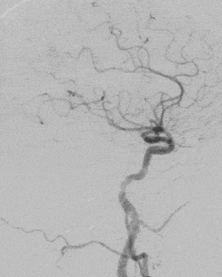 atlas病例集丨伍健明atlas支架辅助动脉瘤栓塞