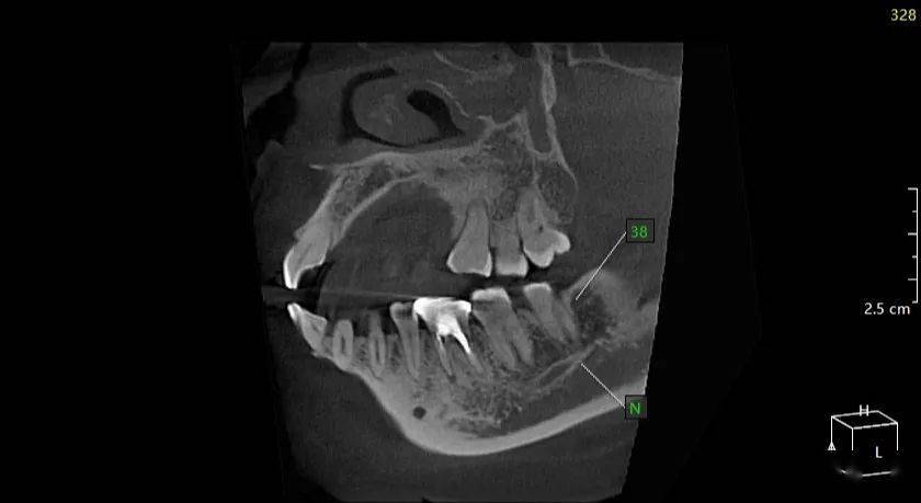 姚xx 20210327 智齿cbct 177xxxx2292