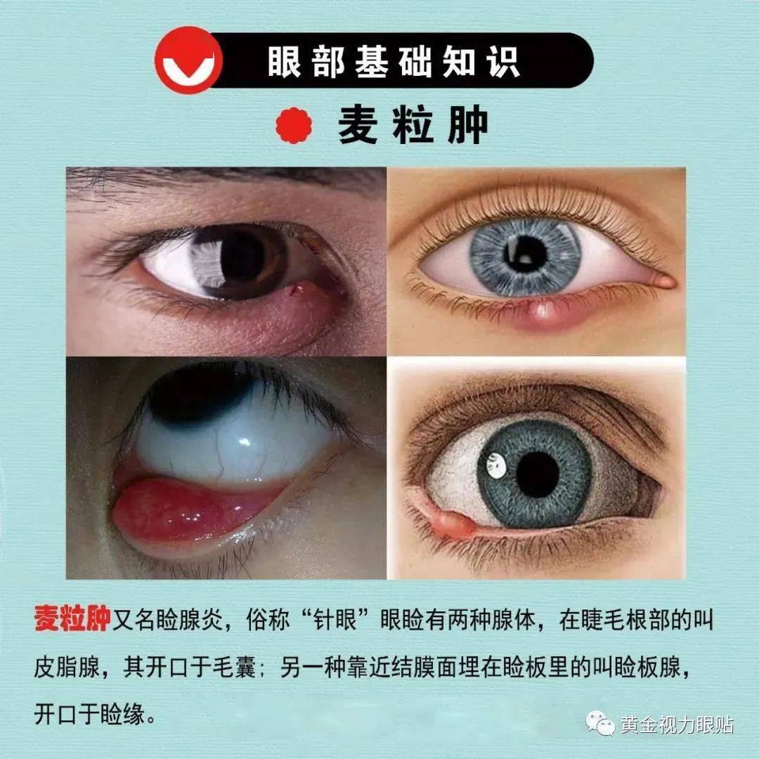 【爱眼知识】麦粒肿(针眼儿),霰(xian)粒肿还在傻傻分不清楚?