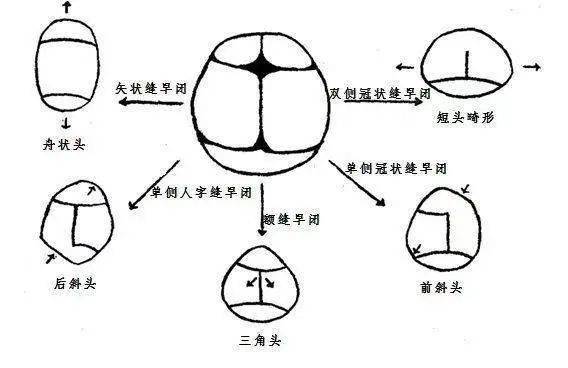 正常颅缝及颅骨示意图