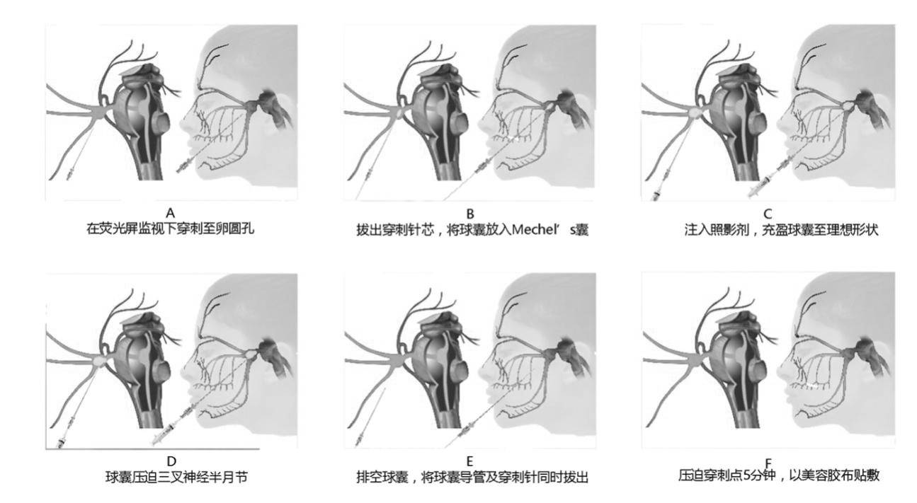 经皮三叉神经半月节微球囊压迫术治疗三叉神经痛