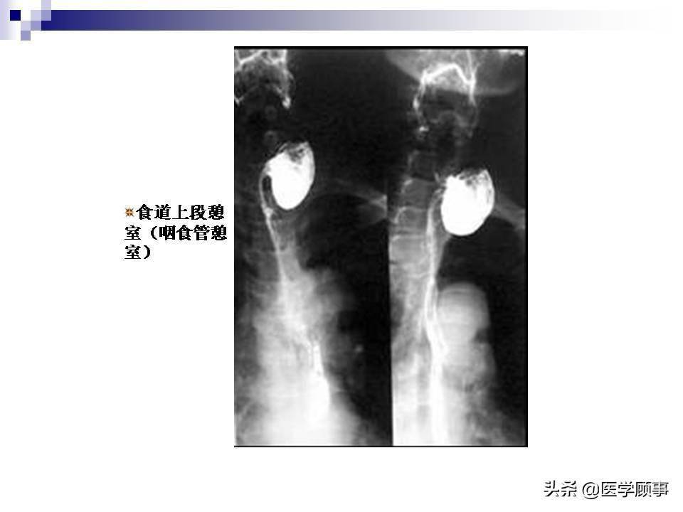 食道癌科普及影像分析