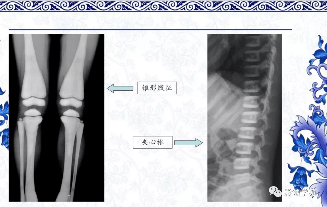 7种常见的骨软骨发育异常x线表现