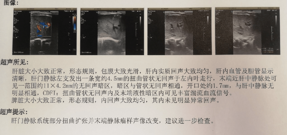 图源:作者提供 点击图片可查看大图 肝脏彩超提示血管瘤改变,湍流丰富