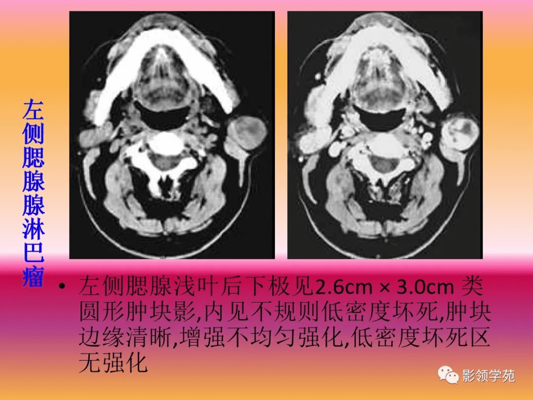 腮腺疾病的ct诊断与鉴别诊断