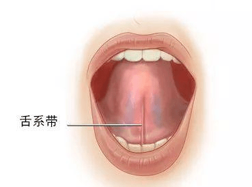 舌系带过短是指由于舌下系带的牵拉,伸舌时舌尖凹陷,舌头不能完全伸