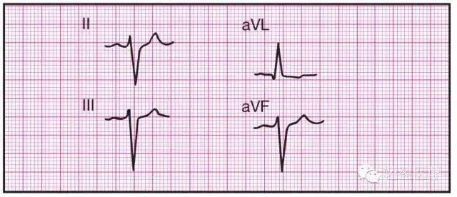 最全面的异常心电参考图,建议收藏!