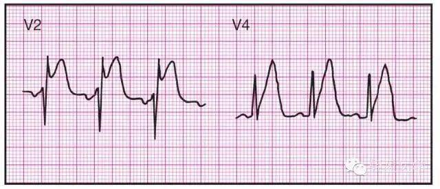 最全面的异常心电参考图,建议收藏!