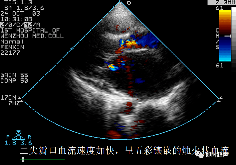 心脏瓣膜病超声诊断_二尖瓣