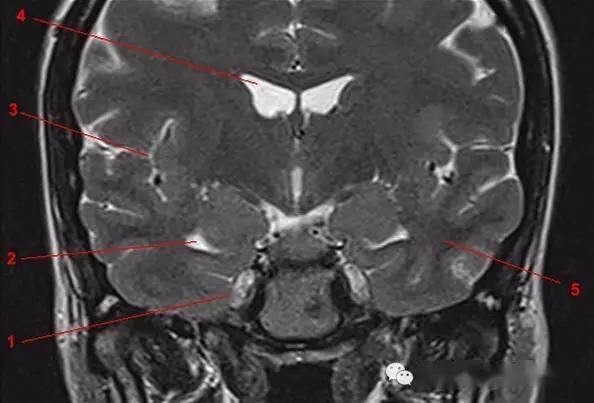 鞍区,垂体磁共振(mri)解剖——冠状面