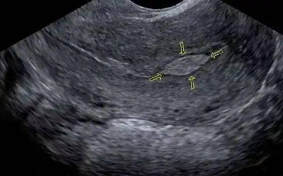 b超报告上写"子宫内膜17mm,宫腔实质样结构.
