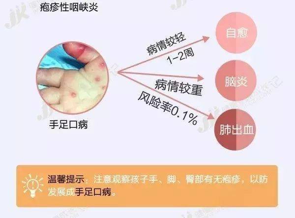 进入夏季幼儿园疱疹性咽峡炎高发期,家长老师做好预防