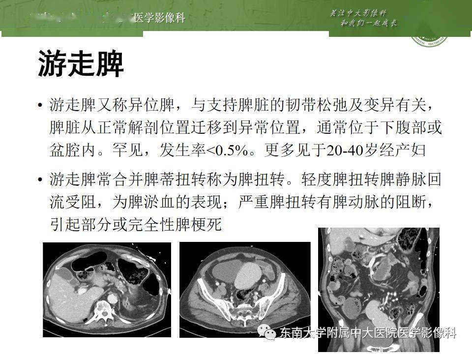 编辑/校对:郑孝飞 副脾影像表现 责任编辑