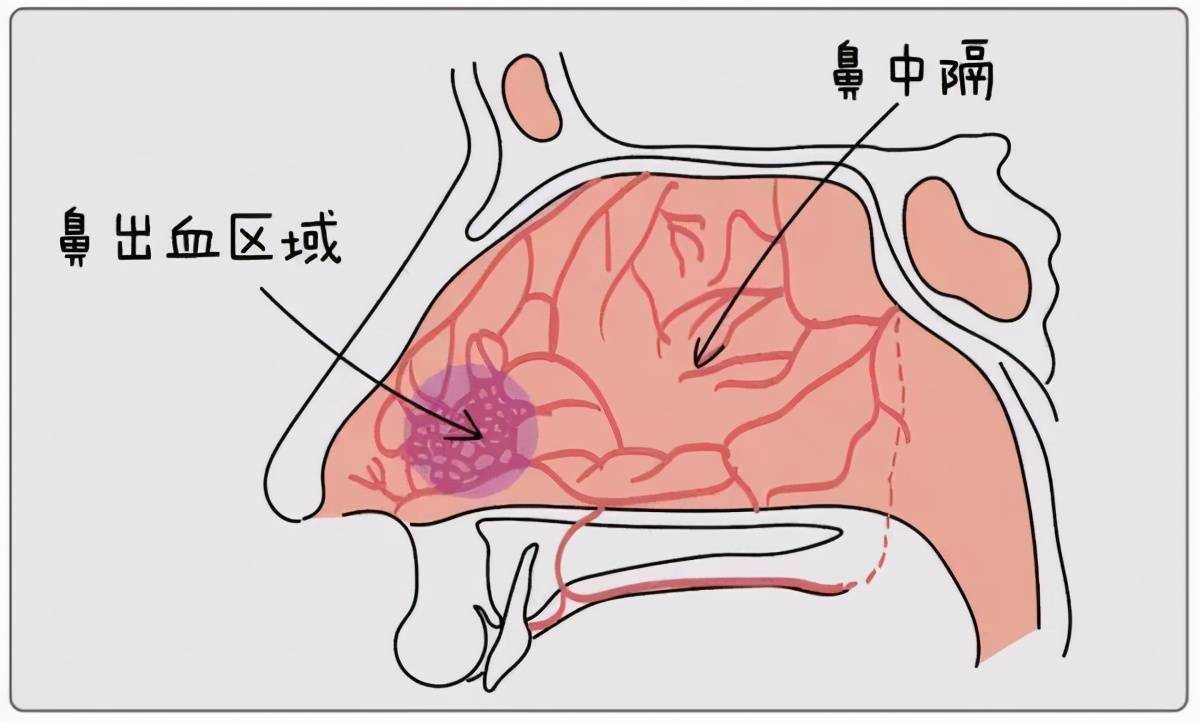 你看,上图的圈圈处是鼻部血管最丰富的地方,也是最容易出血的部位.