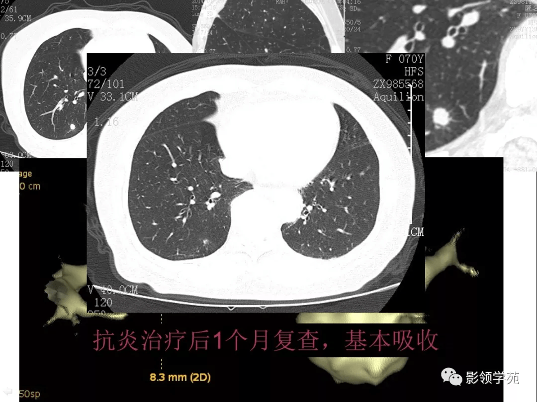 肺良恶性结节ct征象及鉴别诊断