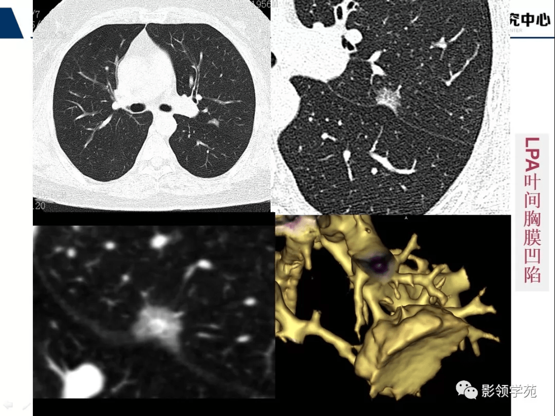 胸膜增厚或凹陷 (五)病灶内血管与支气管情况 血管征 空气支气管征 ct