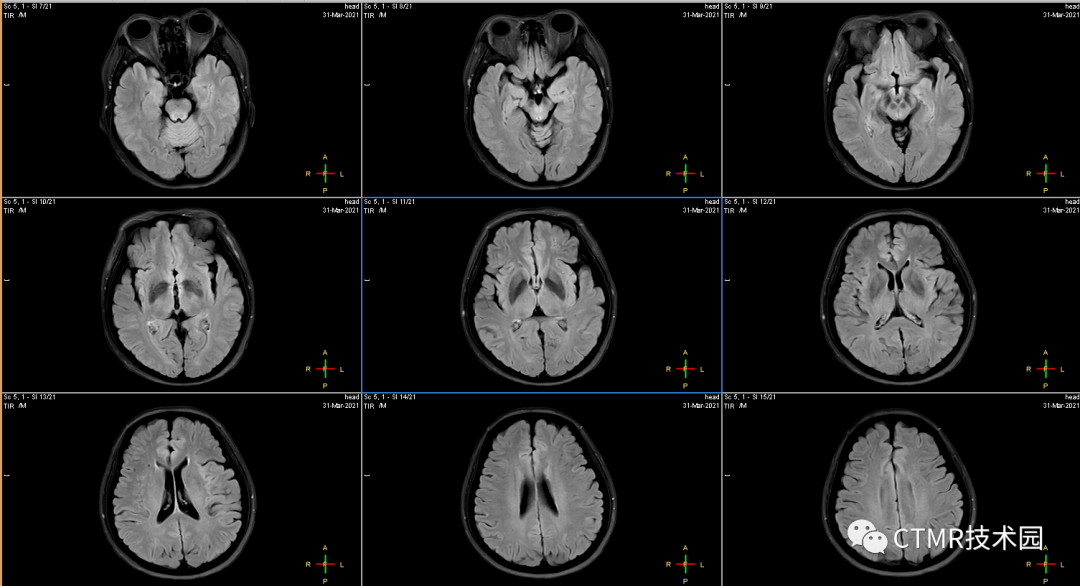 手把手教你基础:颅脑 mr 平扫及后处理_序列