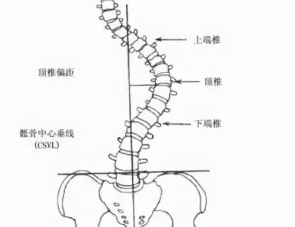 青少年脊柱弯曲的越来越多,特别是尾椎骨那一段.